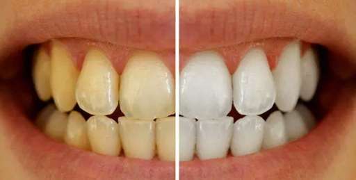 dişçi diş beyazlatma öncesi sonrası