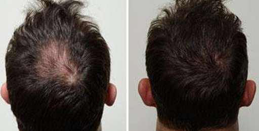saç kök hücre tedavisi sonrasi sonucu